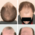 Using Secure Websites for Hair Loss Prevention