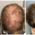 Understanding Minoxidil: The Solution for Hair Loss
