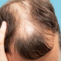 Lifestyle Factors That Can Help Prevent Baldness and Hair Loss