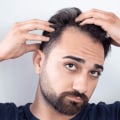 Preventing Baldness and Hair Loss: A Comprehensive Guide