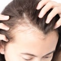Understanding Female Hair Loss: Causes, Diagnosis, and Treatment Options
