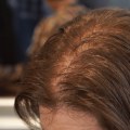 Hairstyles for Thinning Hair: Tips and Solutions