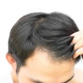 Exercise for Hair Health: Tips and Techniques to Prevent Baldness and Promote Hair Regrowth