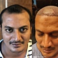 The Truth About Hair Transplants: What You Need to Know