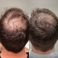 Stress Management for Hair Health: Tips and Techniques for Hair Regrowth