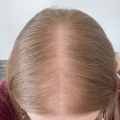 Avoiding Online Scams: Tips for Preventing Hair Loss and Other Problems