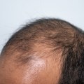Preventing Baldness and Hair Loss: Understanding the Role of Genetics