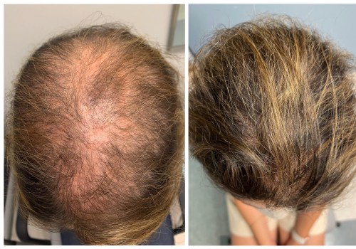 Understanding Minoxidil: The Solution for Hair Loss