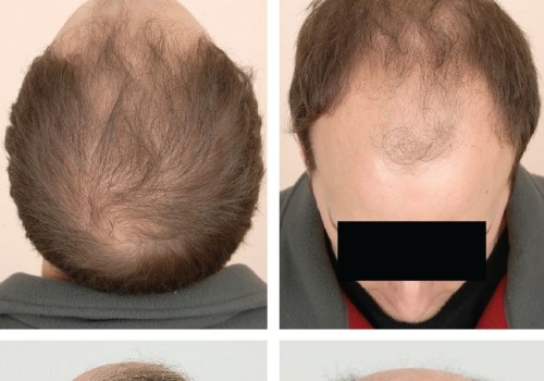 Lifestyle Factors and Male Pattern Baldness: Everything You Need to Know