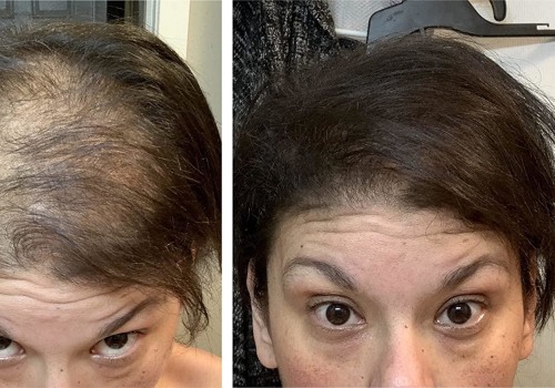 Covering All About Hair Fibers: Solutions for Hair Loss and Baldness