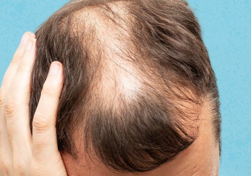 Lifestyle Factors That Can Help Prevent Baldness and Hair Loss