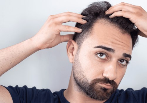 Preventing Baldness and Hair Loss: A Comprehensive Guide