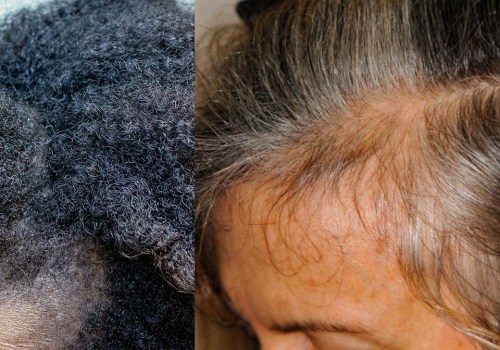 How to Manage Relationship Stress and Prevent Hair Loss