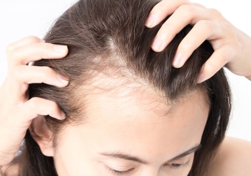 Understanding Female Hair Loss: Causes, Diagnosis, and Treatment Options