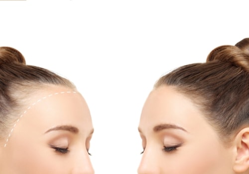 Lifestyle Changes for Preventing Female Hair Loss: Understanding the Causes and Solutions