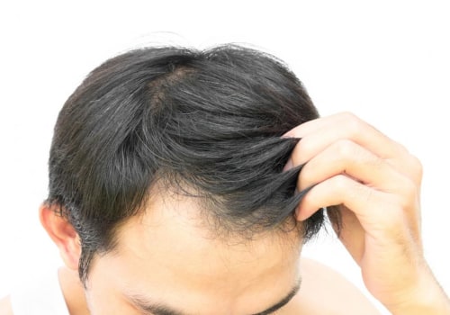 Exercise for Hair Health: Tips and Techniques to Prevent Baldness and Promote Hair Regrowth