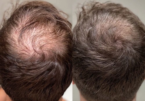 Stress Management for Hair Health: Tips and Techniques for Hair Regrowth