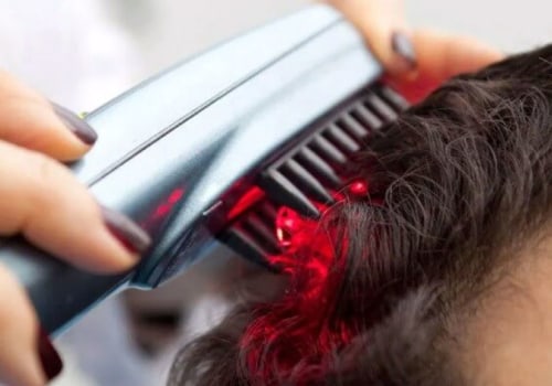 Low-Level Laser Therapy (LLLT) for Hair Loss: Solutions and Treatments