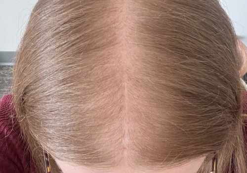Avoiding Online Scams: Tips for Preventing Hair Loss and Other Problems