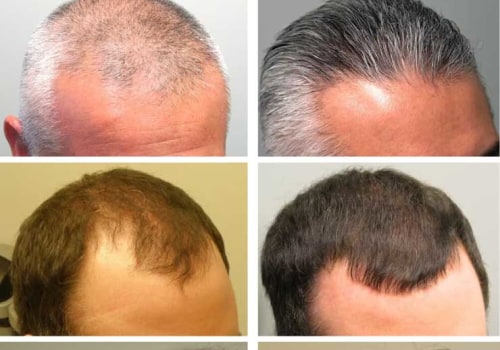Understanding Finasteride for Hair Loss
