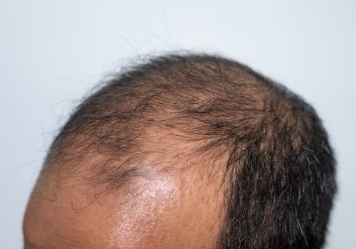 Preventing Baldness and Hair Loss: Understanding the Role of Genetics